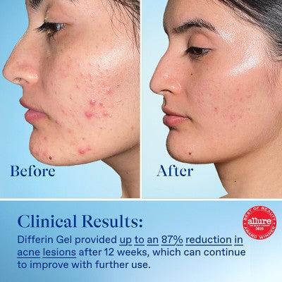 Differin Acne Retinoid Face and Body Treatment Gel Adapalene 0.1% 45g - Imperfect Box