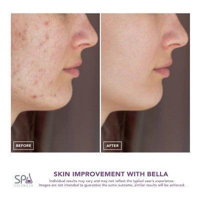 Spa Sciences BELLA 3-in-1 Diamond Tip Microdermabrasion System - New
