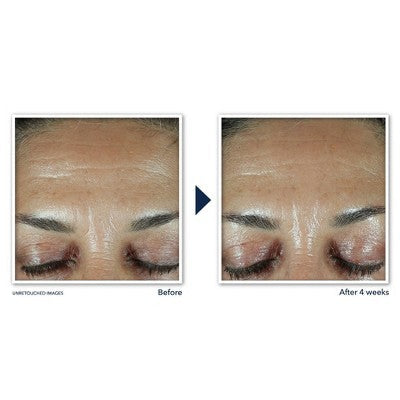 RoC Retinol Correxion Deep Wrinkle Filler 1 fl oz - Imperfect Box